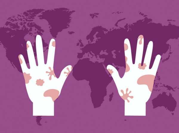 D&iacute;a Mundial de la Lepra