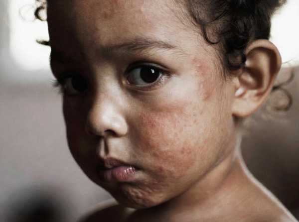 CDC-Minsa, notificaci&oacute;n y sarampi&oacute;n